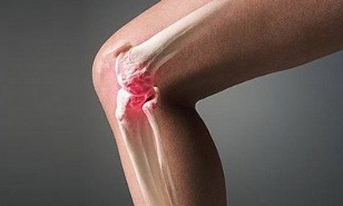 How arthritis is different from osteoarthritis