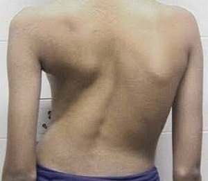 scoliosis as a cause of back pain