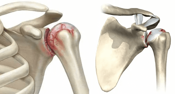 what arthrosis of the shoulder joint looks like