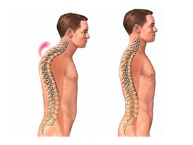 Spinal kyphosis