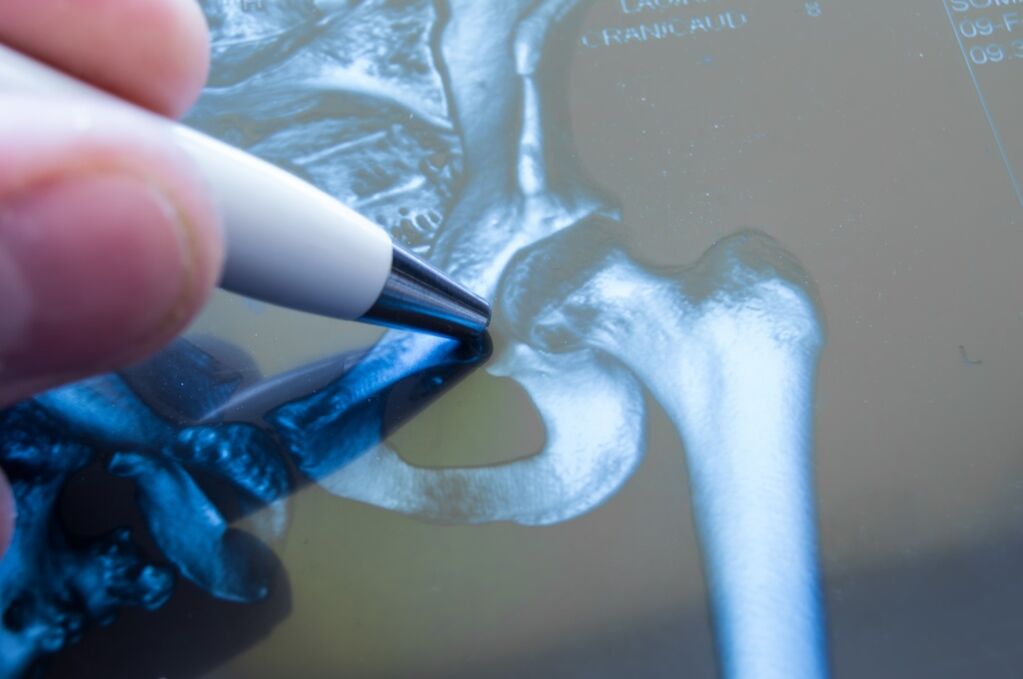 Osteoarthritis of the hip joint on radiography