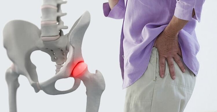 Pain in the hip area - a sign of osteoarthritis of the hip joint