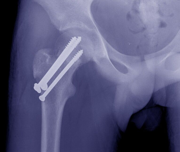 X-ray of the hip joint, fractured osteosynthesis with internal fixation devices