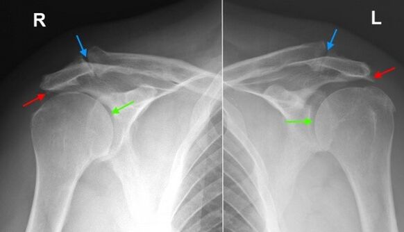 Radiography of the shoulder joints