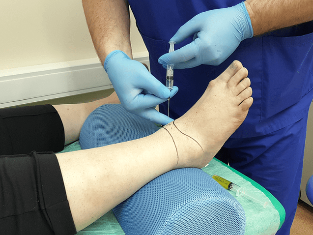 puncture for arthrosis of the ankle joint