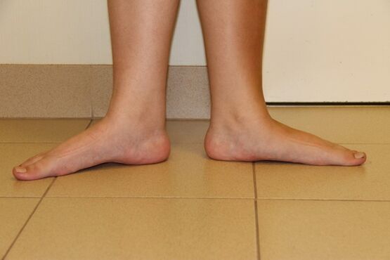 Sometimes the cause of the neck arithe is a flat foot