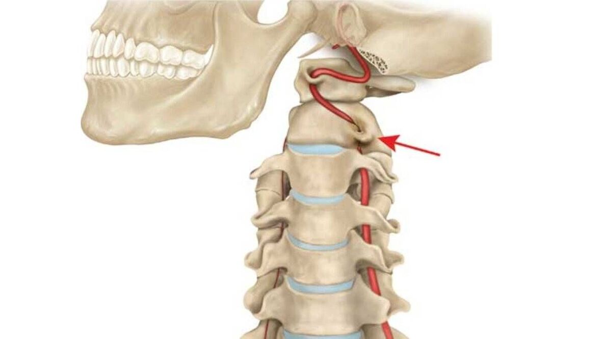 osteochondrosis of the cervical spine