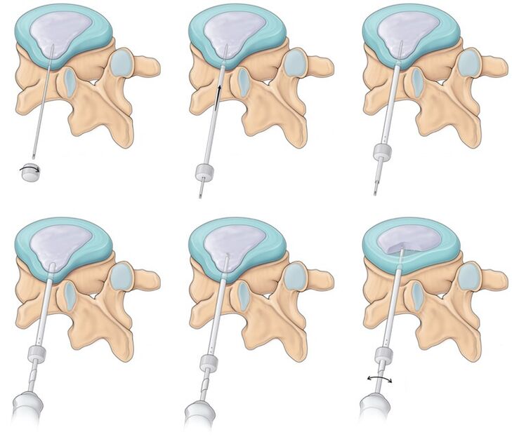 surgery for back pain