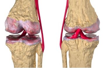 Varicose veins are the reason for the development of gonarthrosis